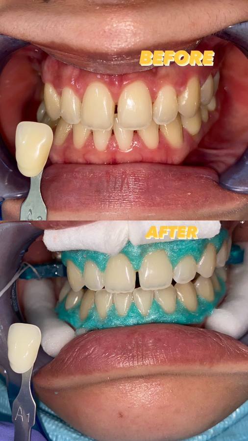 Treatment Bleaching — Klinik Jasamedika